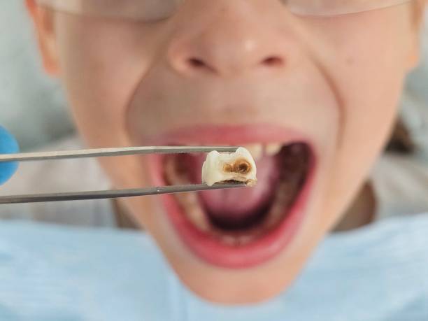 Best Emergency Wisdom Teeth Removal in Apalachin, NY
